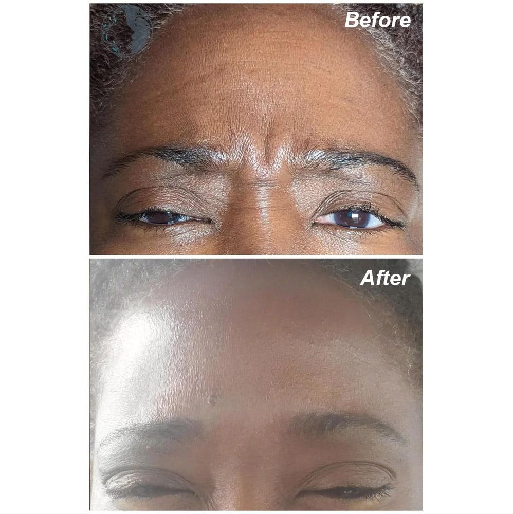 BOTOX before & after | Ethereal Aesthetics