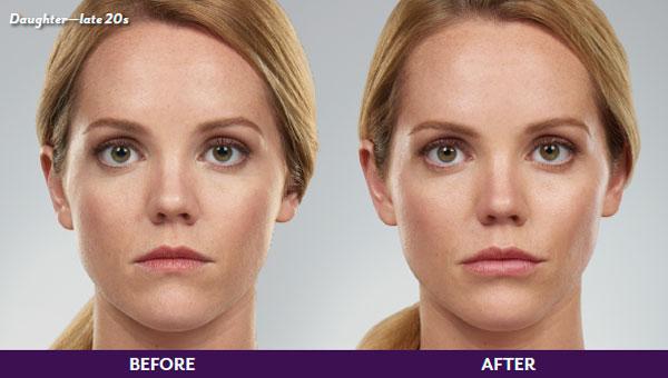 JUVÉDERM before & after | Ethereal Aesthetics