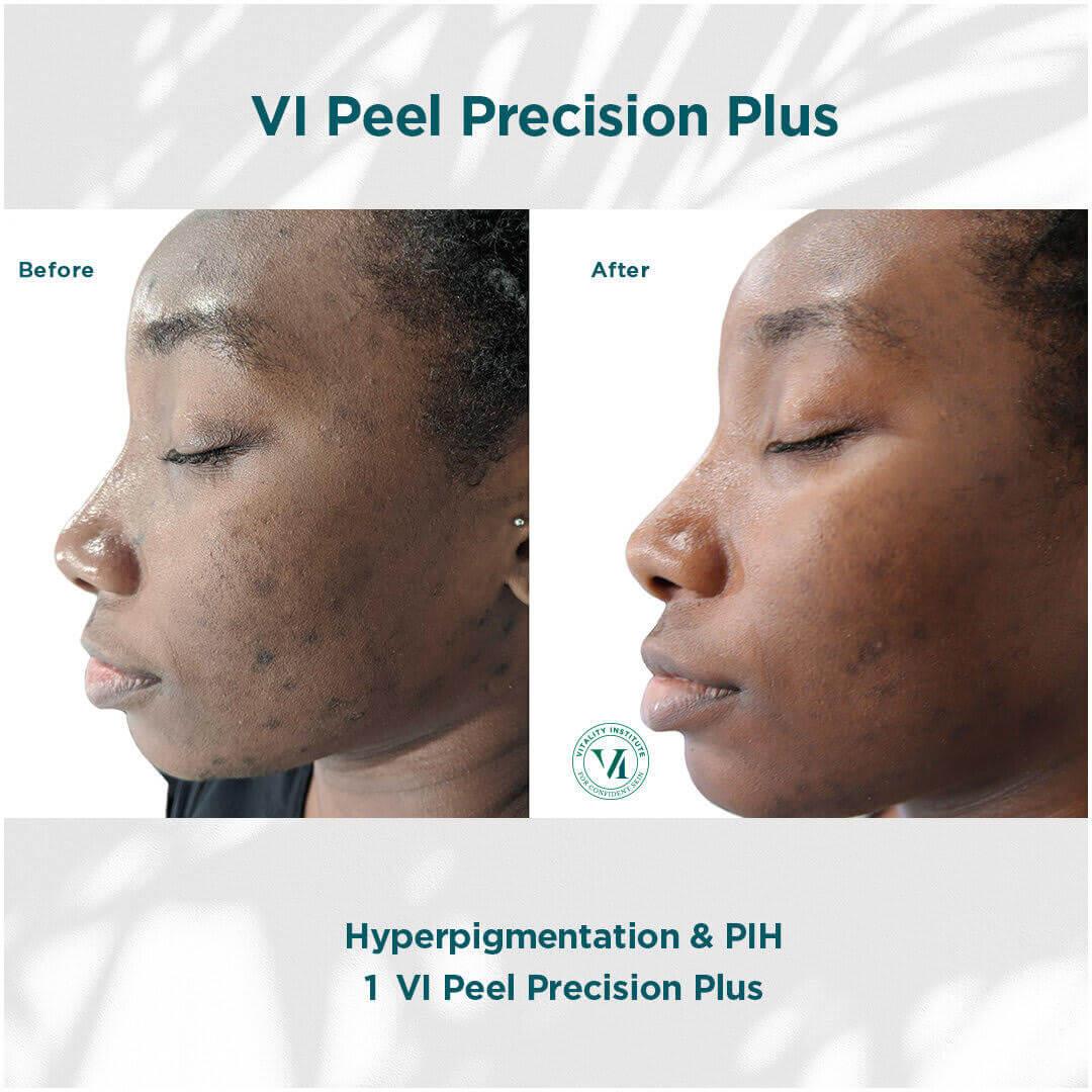 VI PEEL before & after | Ethereal Aesthetics