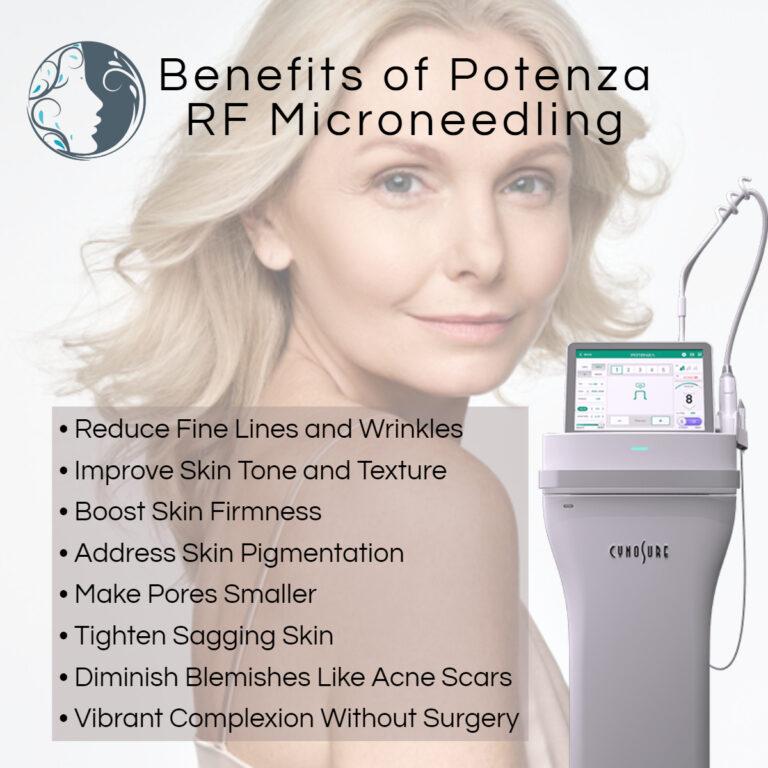 benefits of potenza rf microneedling treatments at ethereal aesthetics vancouver washington