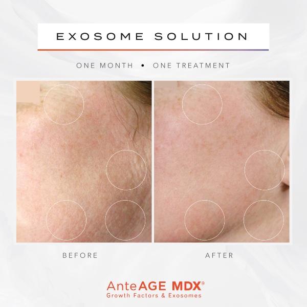 exosome before and after ethereal aesthetics vancouver wa