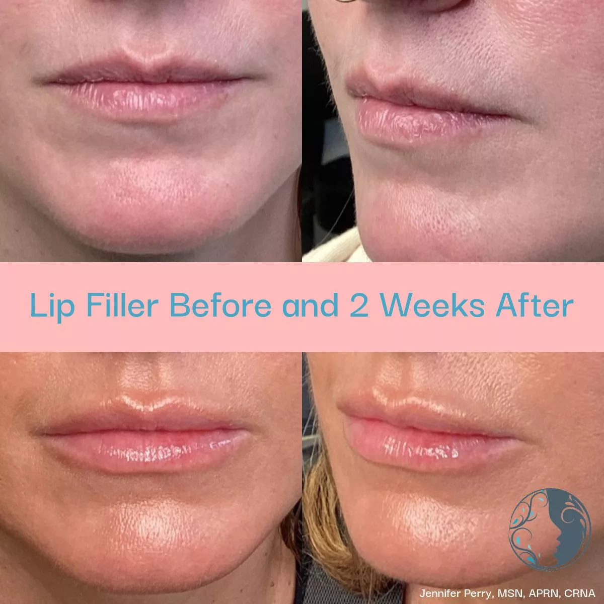 lip filler injection vancouver wa medical spa treatment ethereal aesthetics before and after