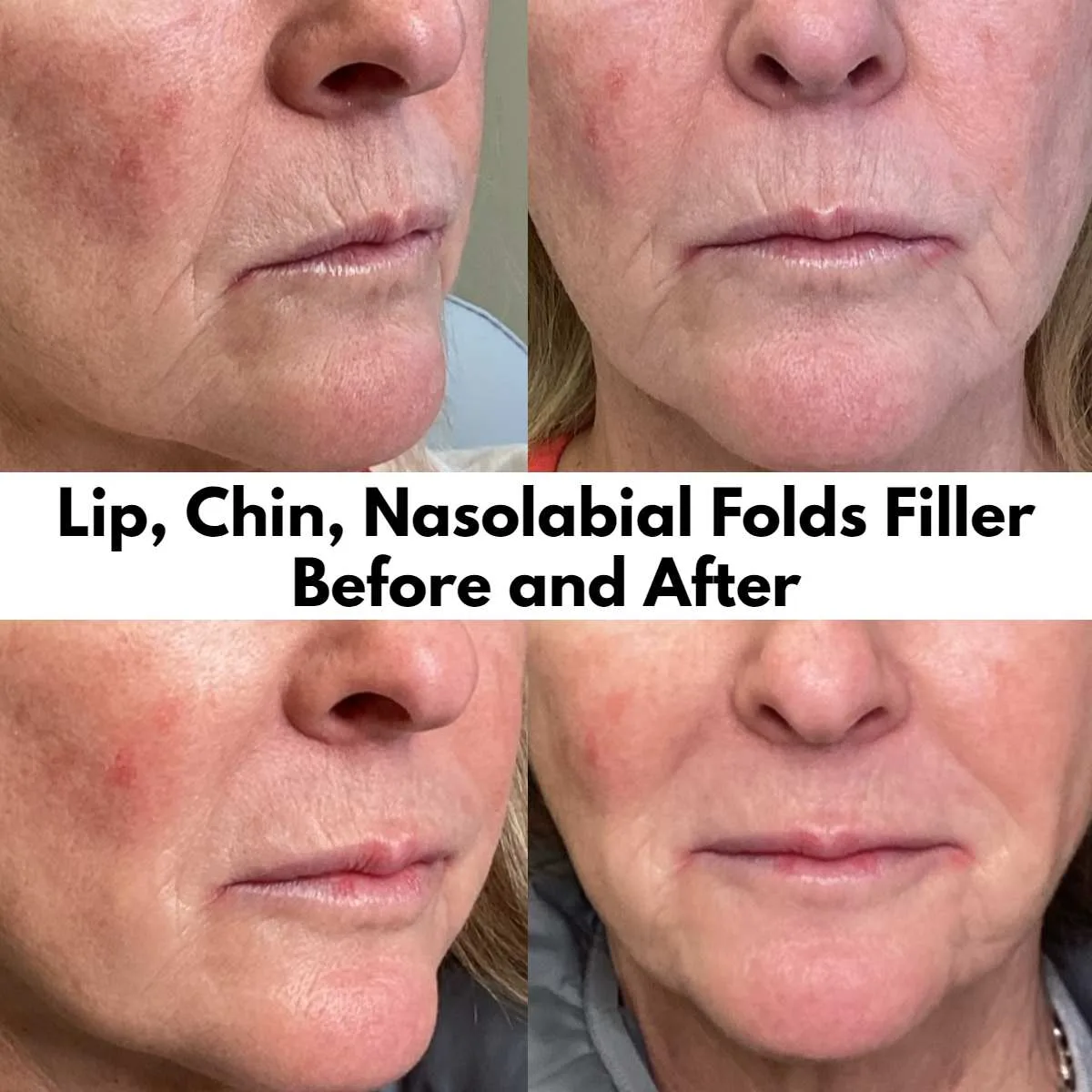 Lip, Chin, Nasolabial Folds Filler Before and After