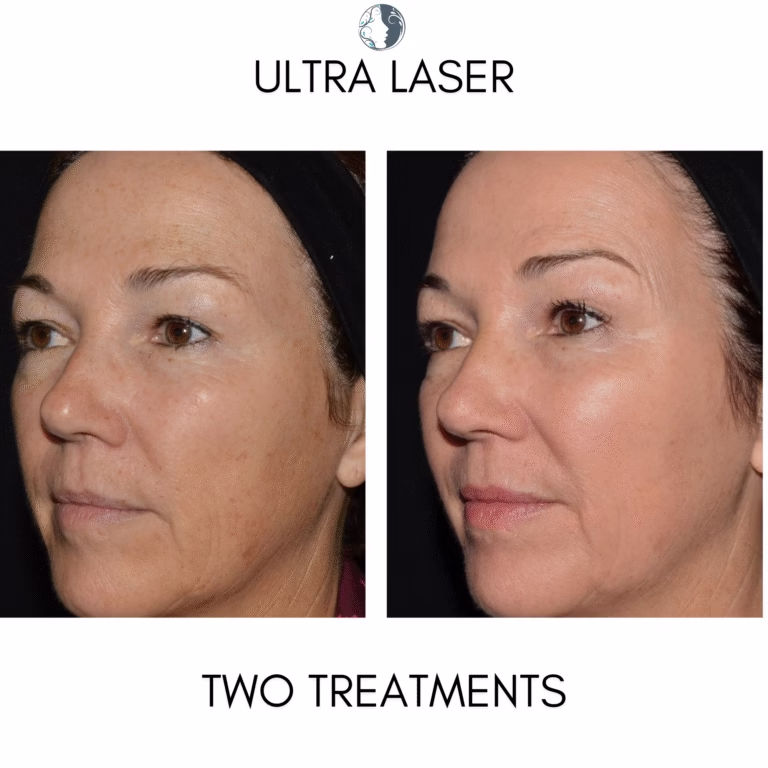 ultra laser before and after ethereal aesthetics vancouver, wa