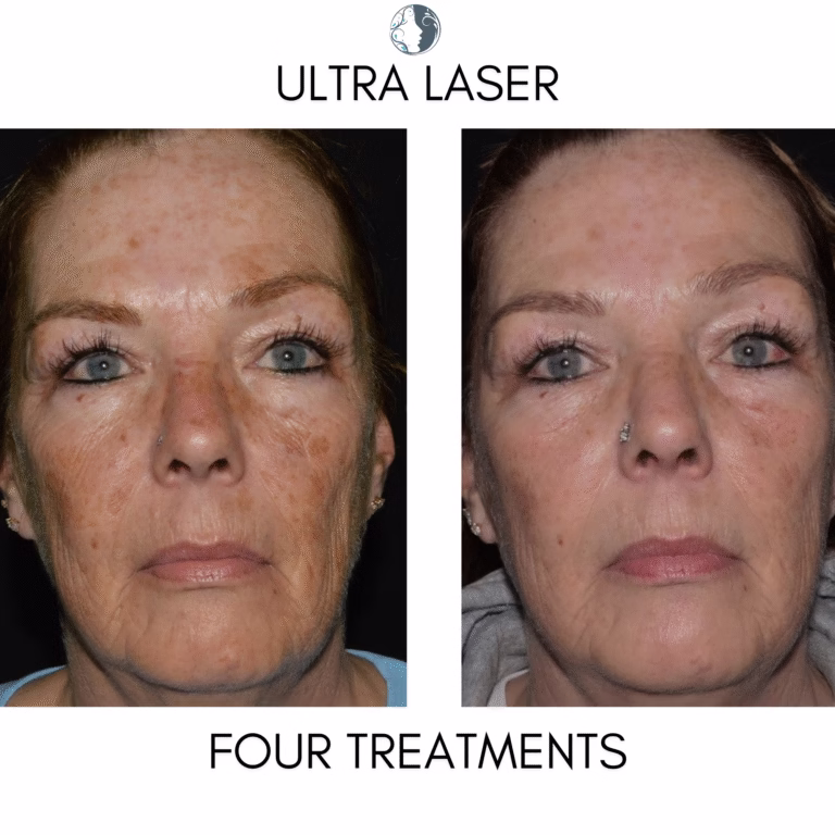 ultra laser before and after ethereal aesthetics vancouver, wa