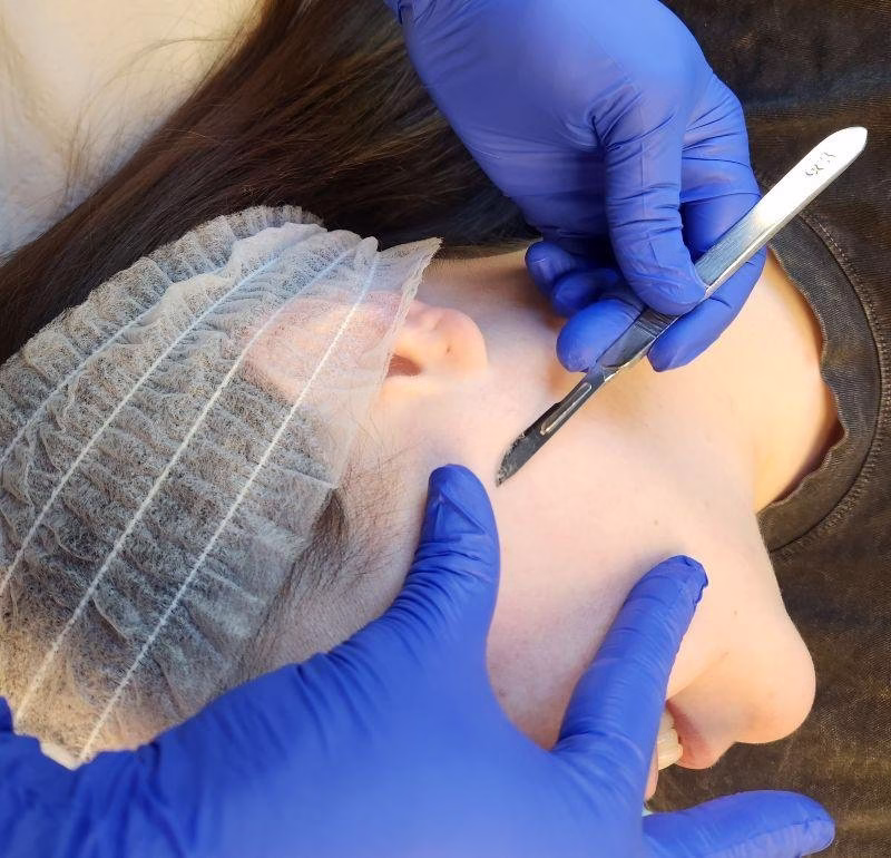 Dermaplaning